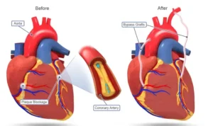 CABG (Coronary Artery Bypass Grafting): Everything You Need to Know