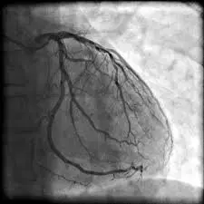 Coronary Angiography: A Comprehensive Guide